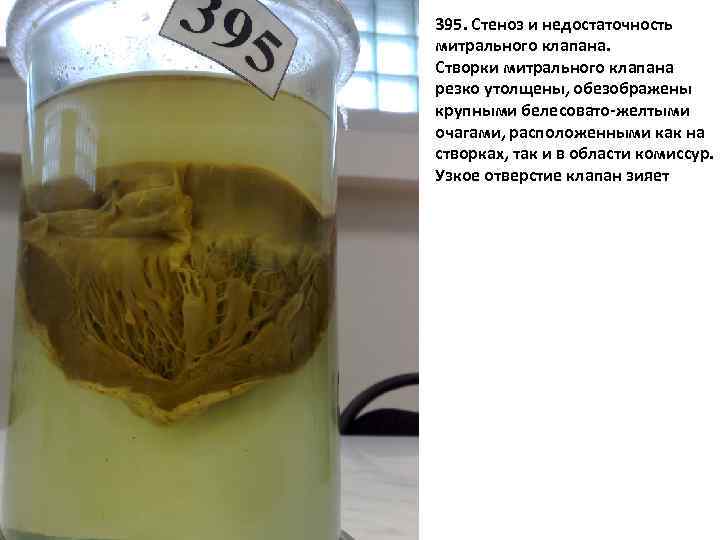 395 395. Стеноз и недостаточность митрального клапана. Створки митрального клапана резко утолщены, обезображены крупными