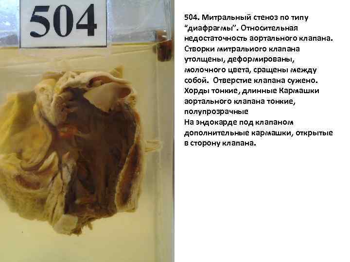504. Митральный стеноз по типу “диафрагмы”. Относительная недостаточность аортального клапана. Створки митральиого клапана утолщены,
