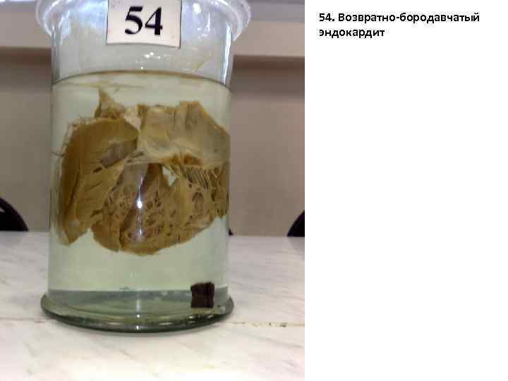 54 54. Возвратно-бородавчатый эндокардит 