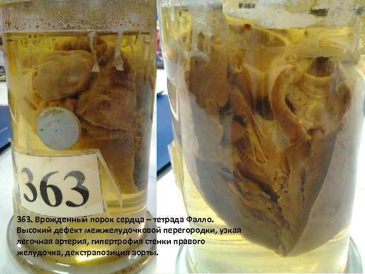 363. Врожденный порок сердца – тетрада Фалло. Высокий дефект межжелудочковой перегородки, узкая легочная артерия,