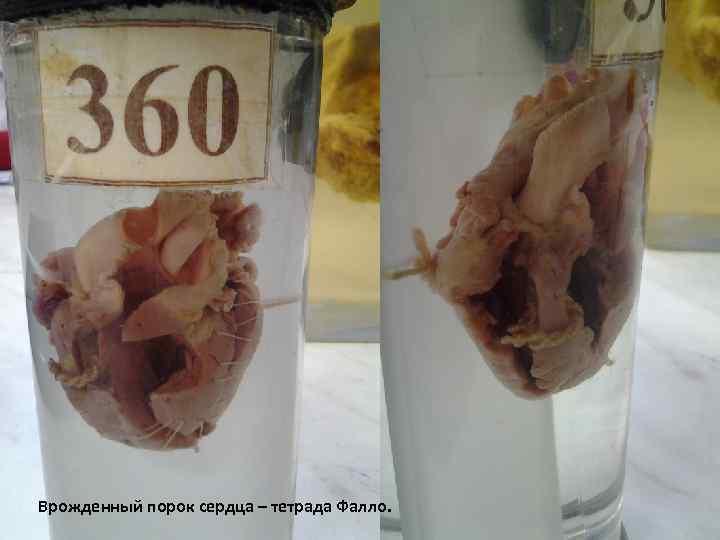Врожденный порок сердца – тетрада Фалло. 