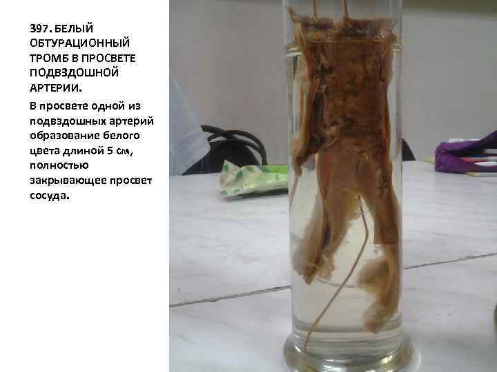 397. БЕЛЫЙ ОБТУРАЦИОННЫЙ ТРОМБ В ПРОСВЕТЕ ПОДВЗДОШНОЙ АРТЕРИИ. В просвете одной из подвздошных артерий