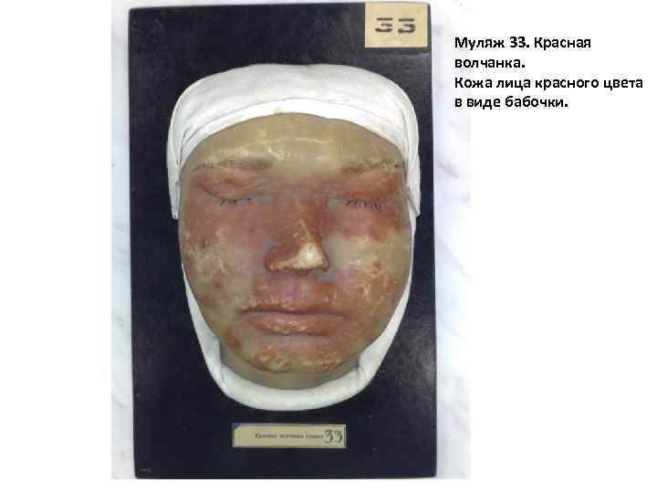 Муляж 33. Красная волчанка. Кожа лица красного цвета в виде бабочки. 