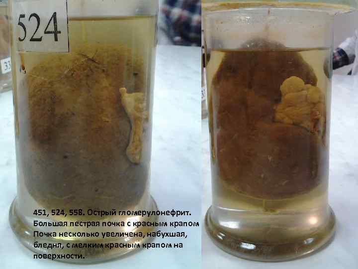 451, 524, 558. Острый гломерулонефрит. Большая пестрая почка с красным крапом Почка несколько увеличена,