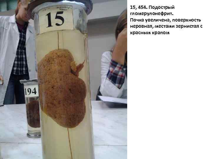 15, 454. Подострый гломерулонефрит. Почка увеличена, поверхность неровная, местами зернистая с красным крапом 