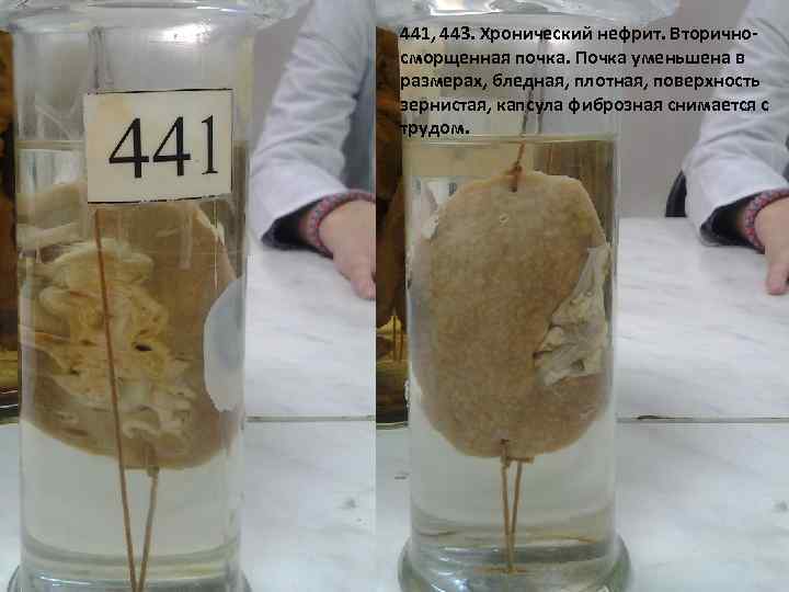 441, 443. Хронический нефрит. Вторичносморщенная почка. Почка уменьшена в размерах, бледная, плотная, поверхность зернистая,