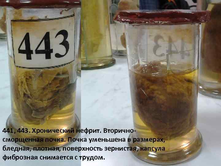 441, 443. Хронический нефрит. Вторичносморщенная почка. Почка уменьшена в размерах, бледная, плотная, поверхность зернистая,