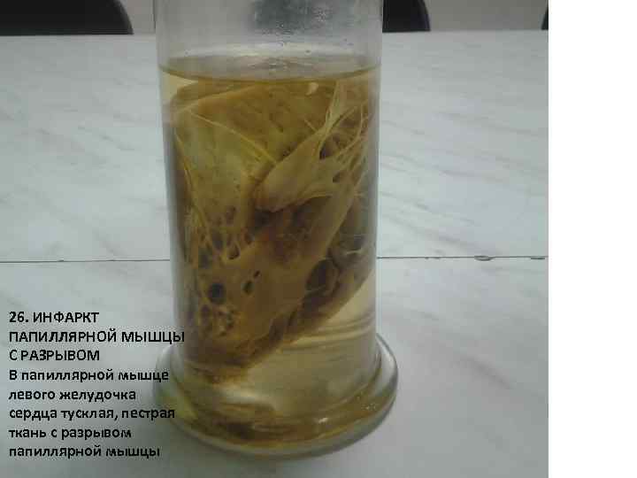 26. ИНФАРКТ ПАПИЛЛЯРНОЙ МЫШЦЫ С РАЗРЫВОМ В папиллярной мышце левого желудочка сердца тусклая, пестрая