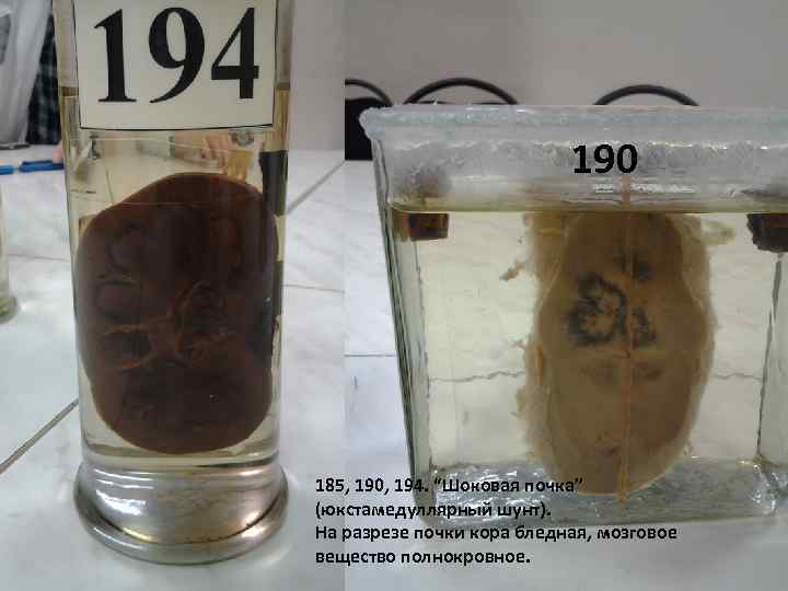 190 185, 190, 194. “Шоковая почка” (юкстамедуллярный шунт). На разрезе почки кора бледная, мозговое