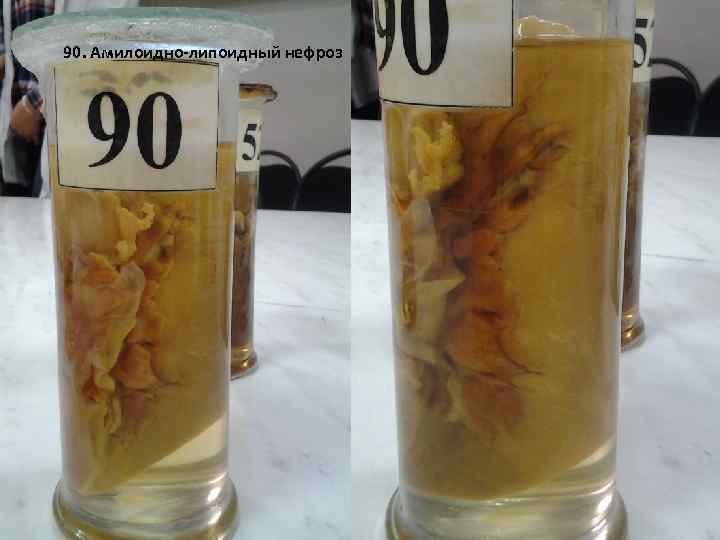 90. Амилоидно-липоидный нефроз 