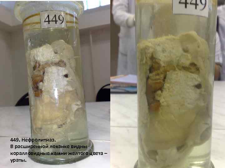 Занятие 4 БОЛЕЗНИ ПОЧЕК 449. Нефролитиаз. В расширенной лоханке видны коралловидные камни желтого цвета