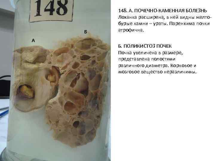 Б А 148. А. ПОЧЕЧНО-КАМЕННАЯ БОЛЕЗНЬ Лоханка расширена, в ней видны желтобурые камни –