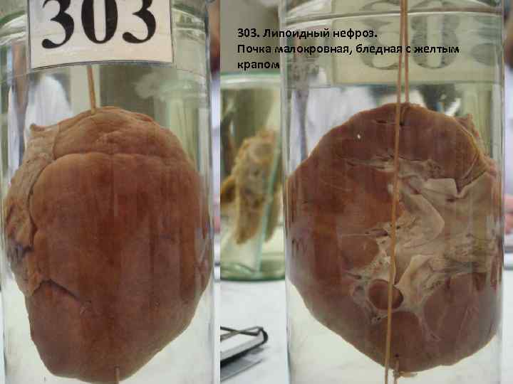 303. Липоидный нефроз. Почка малокровная, бледная с желтым крапом 303 