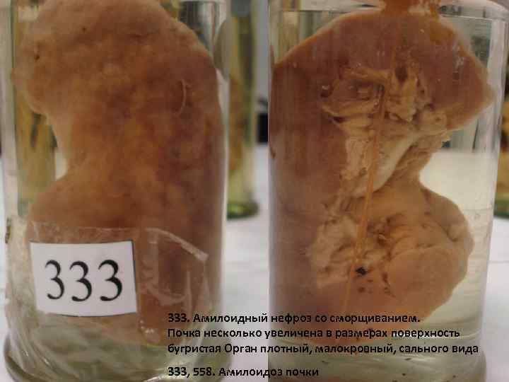 333 333. Амилоидный нефроз со сморщиванием. Почка несколько увеличена в размерах поверхность бугристая Орган
