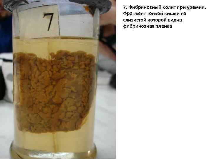 7. Фибринозный колит при уремии. Фрагмент тонкой кишки на слизистой которой видна фибринозная пленка