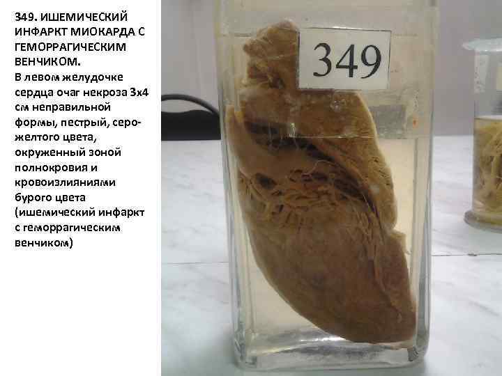 349. ИШЕМИЧЕСКИЙ ИНФАРКТ МИОКАРДА С ГЕМОРРАГИЧЕСКИМ ВЕНЧИКОМ. В левом желудочке сердца очаг некроза 3