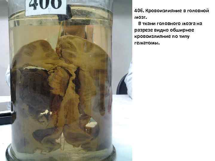 406. Кровоизлияние в головной мозг. В ткани головного мозга на разрезе видно обширное кровоизлияние