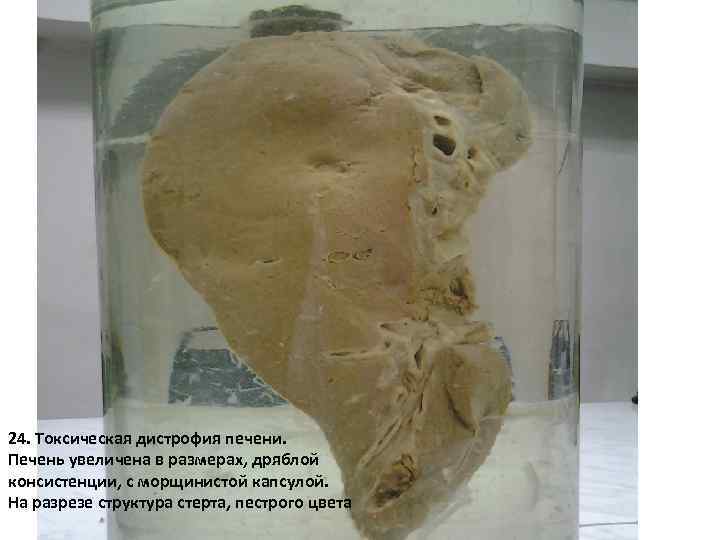 24. Токсическая дистрофия печени. Печень увеличена в размерах, дряблой консистенции, с морщинистой капсулой. На