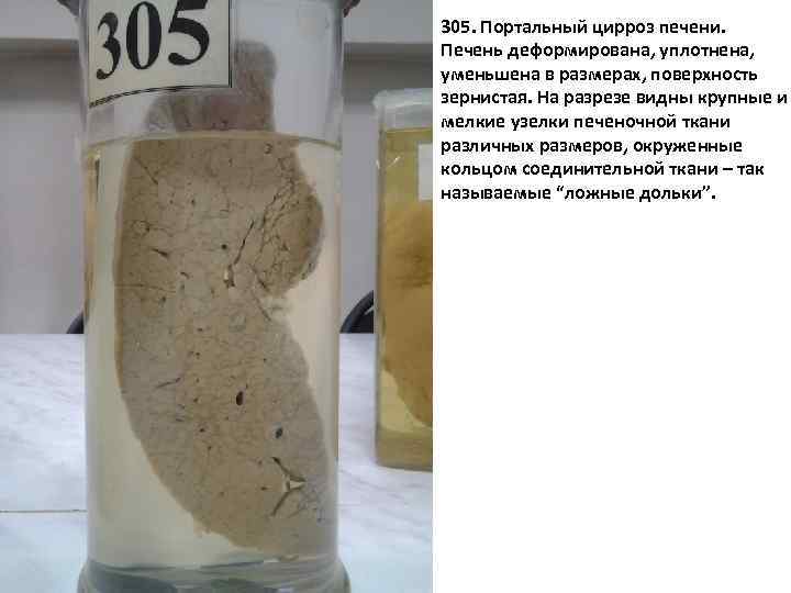 305. Портальный цирроз печени. Печень деформирована, уплотнена, уменьшена в размерах, поверхность зернистая. На разрезе
