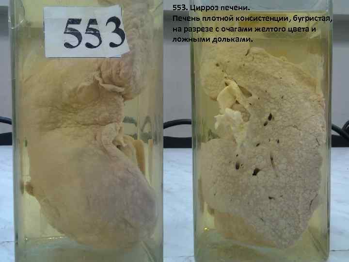 553. Цирроз печени. Печень плотной консистенции, бугристая, на разрезе с очагами желтого цвета и