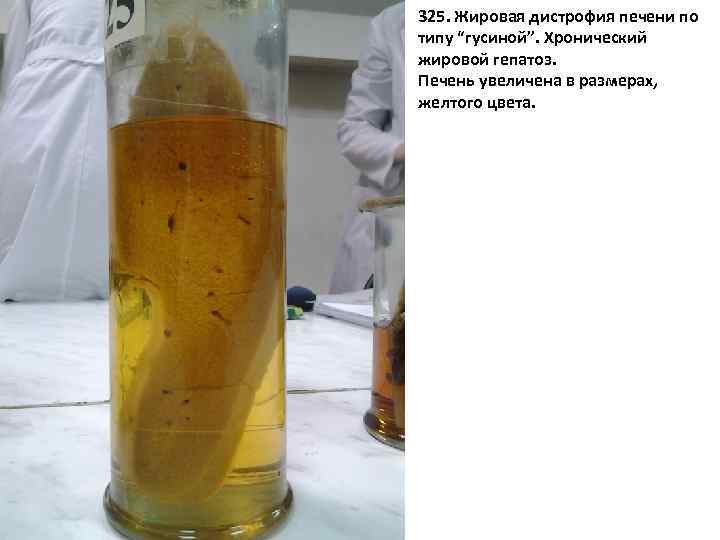 325. Жировая дистрофия печени по типу “гусиной”. Хронический жировой гепатоз. Печень увеличена в размерах,