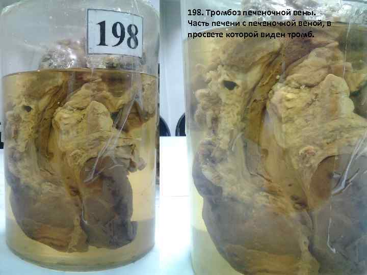 198. Тромбоз печеночной вены. Часть печени с печеночной веной, в просвете которой виден тромб.