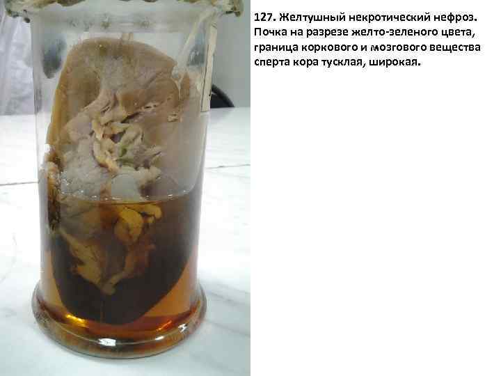 127. Желтушный некротический нефроз. Почка на разрезе желто-зеленого цвета, граница коркового и мозгового вещества