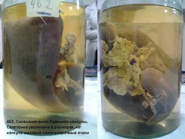 462. Спленомегалия. Гиалиноз капсулы. Селезенка увеличена в размерах, на капсуле матовые полупрозрачные очаги 