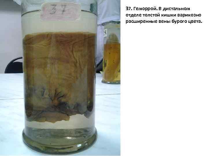 37. Геморрой. В дистальном отделе толстой кишки варикозно расширенные вены бурого цвета. 