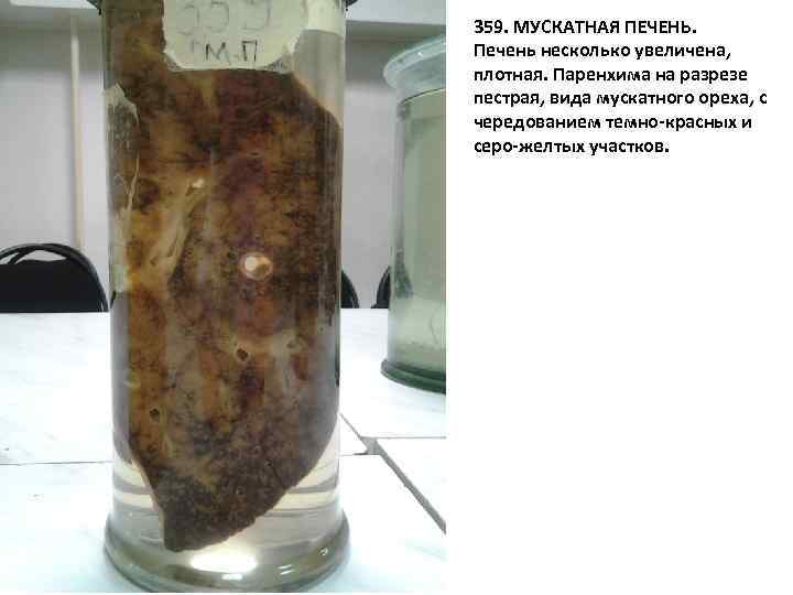 359. МУСКАТНАЯ ПЕЧЕНЬ. Печень несколько увеличена, плотная. Паренхима на разрезе пестрая, вида мускатного ореха,
