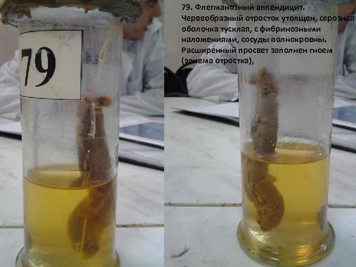 79. Флегманозный аппендицит. Червеобразный отросток утолщен, серозная оболочка тусклая, с фибринозными наложениями, сосуды полнокровны.