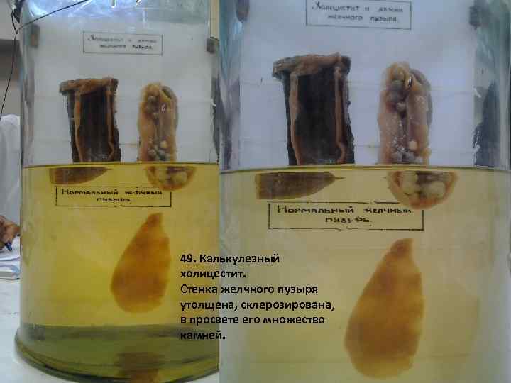 49. Калькулезный холицестит. Стенка желчного пузыря утолщена, склерозирована, в просвете его множество камней. 
