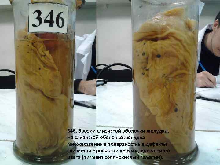 346. Эрозии слизистой оболочки желудка. На слизистой оболочке желудка множественные поверхностные дефекты слизистой с