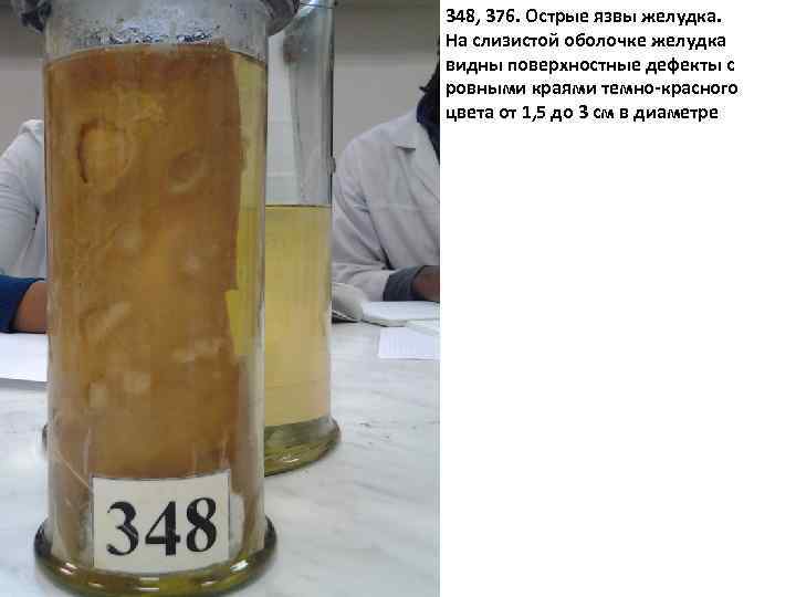 348, 376. Острые язвы желудка. На слизистой оболочке желудка видны поверхностные дефекты с ровными