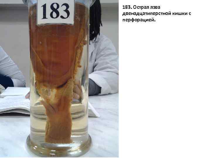 183. Острая язва двенадцатиперстной кишки с перфорацией. 