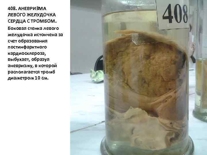 408. АНЕВРИЗМА ЛЕВОГО ЖЕЛУДОЧКА СЕРДЦА С ТРОМБОМ. Боковая стенка левого желудочка истончена за счет