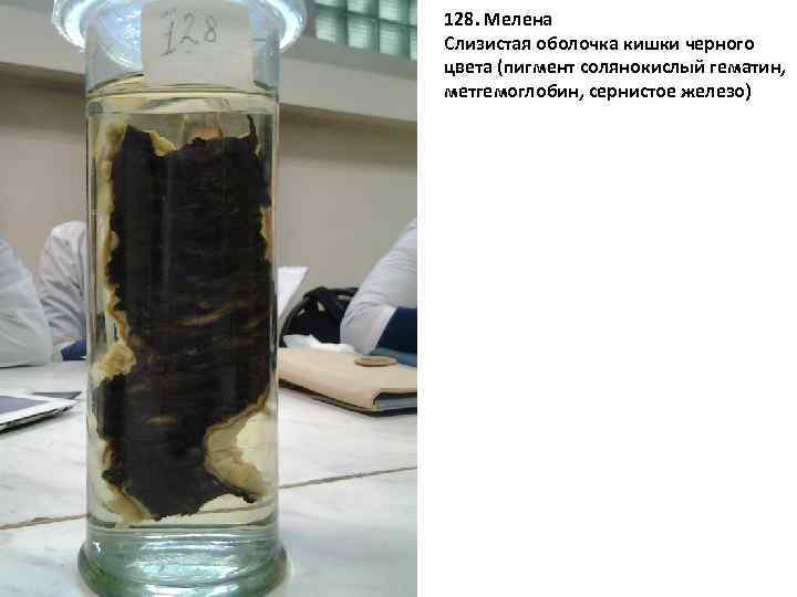 128. Мелена Слизистая оболочка кишки черного цвета (пигмент солянокислый гематин, метгемоглобин, сернистое железо) 