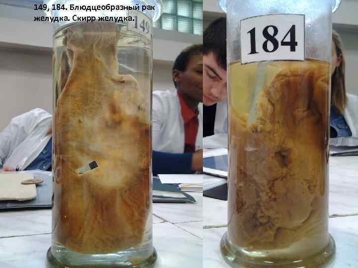 149, 184. Блюдцеобразный рак желудка. Скирр желудка. 