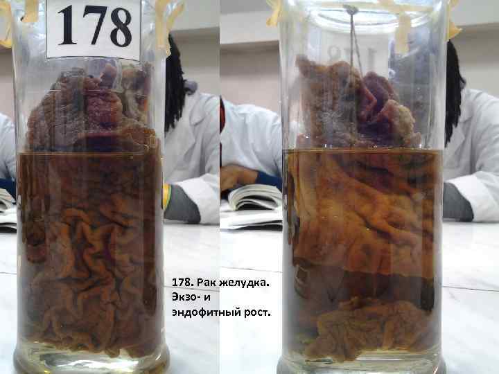 178. Рак желудка. Экзо- и эндофитный рост. 