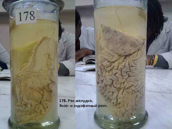 178. Рак желудка. Экзо- и эндофитный рост. 