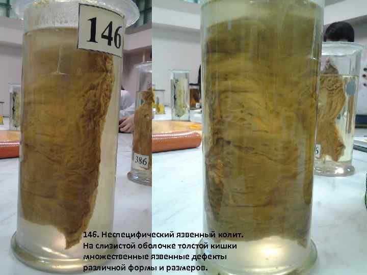 146. Неспецифический язвенный колит. На слизистой оболочке толстой кишки множественные язвенные дефекты различной формы