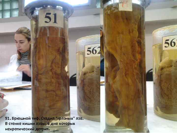 51. Брюшной тиф. Стадия “грязных” язв. В стенке кишки язвы, в дне которых некротический