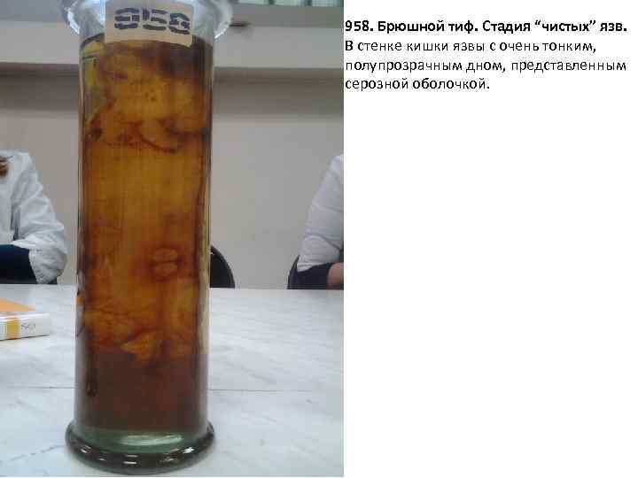 958. Брюшной тиф. Стадия “чистых” язв. В стенке кишки язвы с очень тонким, полупрозрачным