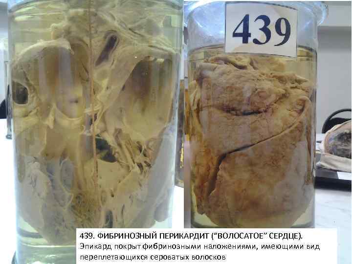 439. ФИБРИНОЗНЫЙ ПЕРИКАРДИТ (“ВОЛОСАТОЕ” СЕРДЦЕ). Эпикард покрыт фибринозными наложениями, имеющими вид переплетающихся сероватых волосков