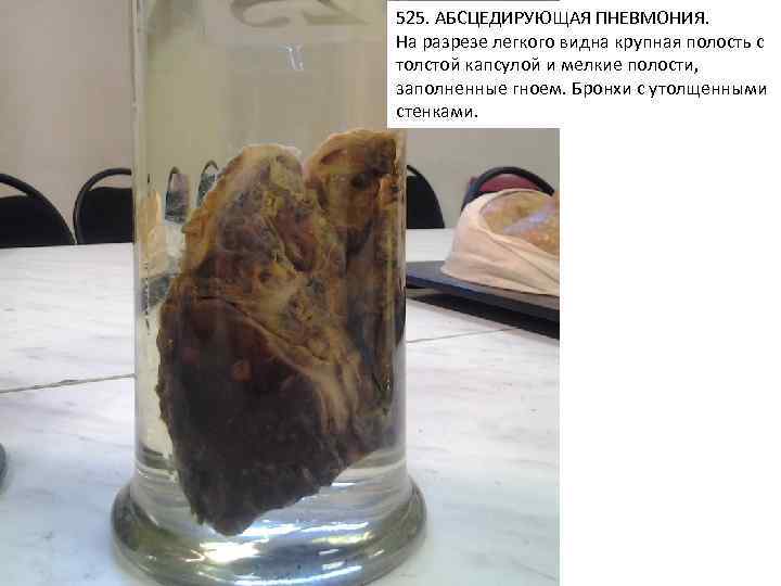 525. АБСЦЕДИРУЮЩАЯ ПНЕВМОНИЯ. На разрезе легкого видна крупная полость с толстой капсулой и мелкие
