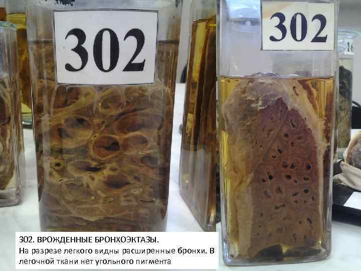 302. ВРОЖДЕННЫЕ БРОНХОЭКТАЗЫ. На разрезе легкого видны расширенные бронхи. В легочной ткани нет угольного