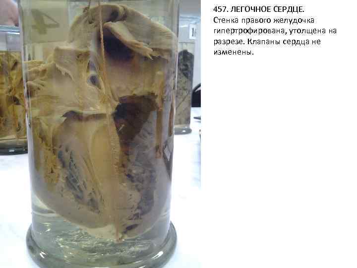 457. ЛЕГОЧНОЕ СЕРДЦЕ. Стенка правого желудочка гипертрофирована, утолщена на разрезе. Клапаны сердца не изменены.