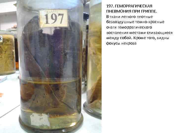 197. ГЕМОРРАГИЧЕСКАЯ ПНЕВМОНИЯ ПРИ ГРИППЕ. В ткани легкого плотные безвоздушные темно-красные очаги геморрагического воспаления