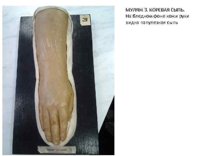 МУЛЯЖ 3. КОРЕВАЯ СЫПЬ. На бледном фоне кожи руки видна папулезная сыпь 