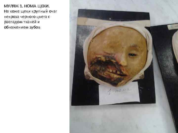 МУЛЯЖ 1. НОМА ЩЕКИ. На коже щеки крупный очаг некроза черного цвета с распадом
